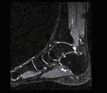 Foot - Saggital T2 FatSepFSE provides homogenous fat supression for confident imaging results