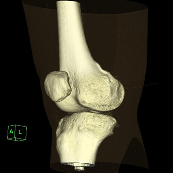 Coloured 3D Volume Rendering reconstruction of helical scan of knee joint.