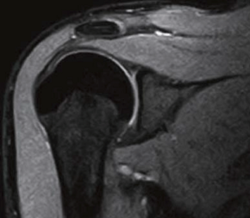 Shoulder - Coronal T2 WFS (Fat Water Separation) technique provides images with fat signal separated in SE, GE and FSE sequences