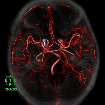 Coloured 3D Volume Rendering reconstruction of post-contrast brain. Detailed visualization of post-operative left cerebral artery aneurysm.