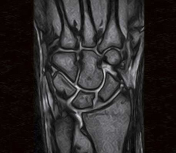 Wrist - Coronal T2 * Gradient Echo the lateral patient table enables easy positioning and optimal image quality 