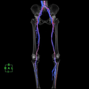 Coloured 3D Volume Rendering reconstruction with fusion images showing arterial (red) and venous (blue) phases using PredictScan (Bolus - Tracking) - ASO (arteriosclerosis obliterans) case.