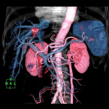 Coloured 3D Volume Rendering reconstruction with fusion images showing arterial and portal phase post contrast abdominal angiography using Intelli EC and PredictScan (Bolus-Tracking). The HCC (hepatocellular carcinoma) is visible in red.